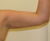 Feel Beautiful - Arm reduction San Diego Case 6 - After Photo